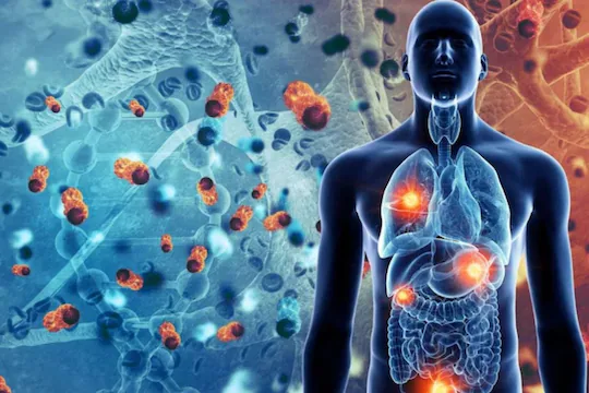 body cancer