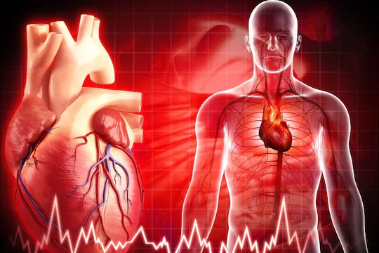 Heart Attack